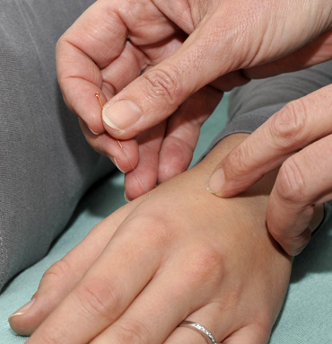Akupunktur in Handrücken
