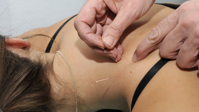 Akupunktur an der Schulter